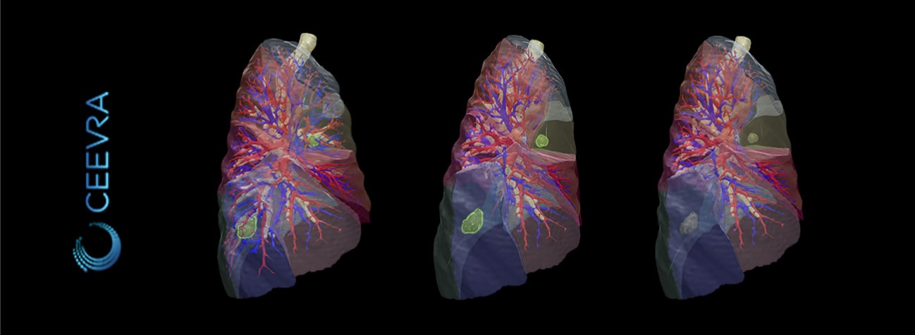 3d model of lungs