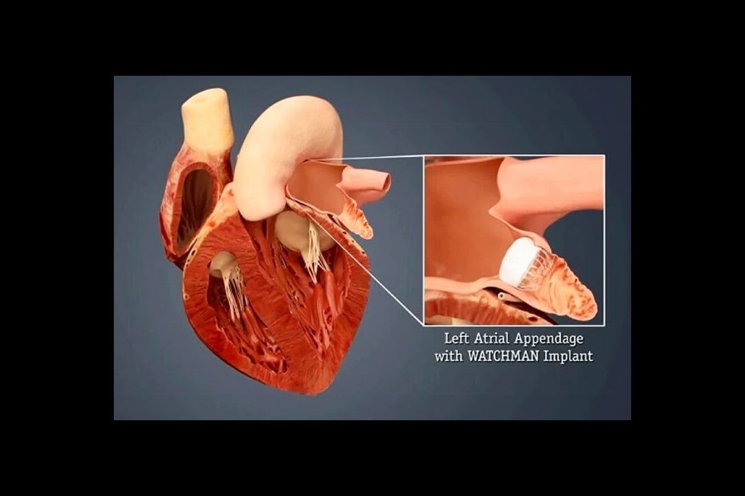 Watchman Cath Lab Electrophysiology for Arrhythmia Care | Stamford Health