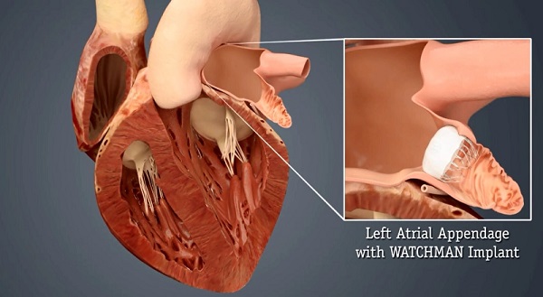 Watchman Devices Near Stamford CT For AFib Stamford Health watchman-devices-near-stamford-ct-for-afib-stamford-health