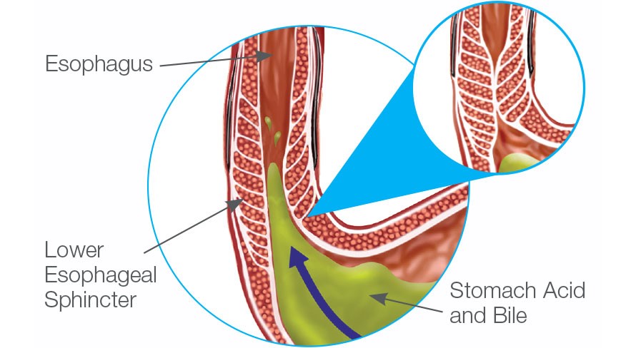 LINX Procedure - Stamford HealthHeartburn, Reflux, and Esophageal Center